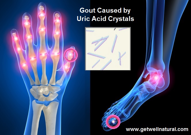 Gout Pain in Human Joint System